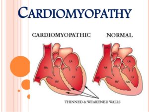 heart disease cardiomyopathy